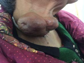 腺象体手术后可以吃瓜吗,瓜类食物的适宜摄入时间  第3张