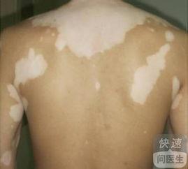 白癜风吃角瓜行吗,白癜风患者的天然食疗选择  第1张